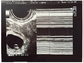 Ultrasonido transvaginal saco gestacional ortotópico con embrión único vivo de 7 mm de LCC con actividad cardiaca