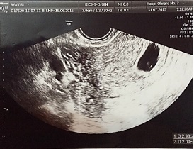 Formación anexial ovoide de 31 x 19 mm en anexo derecho; embarazo heterotópico: uno intrauterino de 6,4 semanas viable y otro ectópico tubario derecho