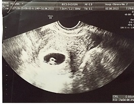 Ultrasonografía transvaginal: embrión único vivo de 9,3 mm de LCC, con actividad cardiaca