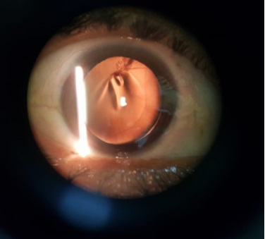 Examen biomicroscópico de segmento anterior bajo midriasis medicamentosa.