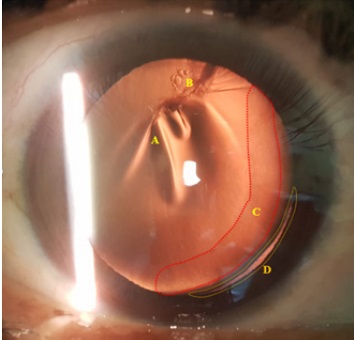 Biomicroscopia por retroiluminación (OD)