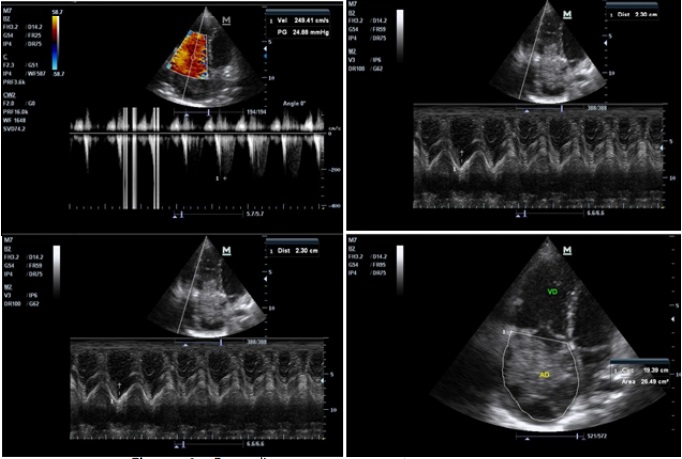 Ecocardiograma que muestra una masa heterogéneo móvil de 8.5 x 6 cm en la aurícula derecha.