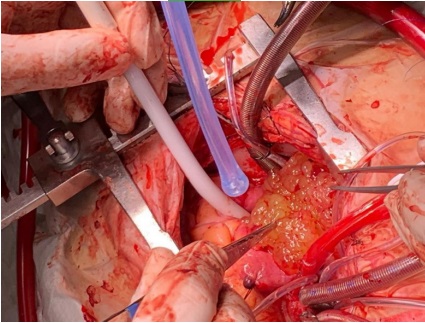 La imagen muestra el mixoma en cavidad auricular derecha durante el periodo transquirúrgico.