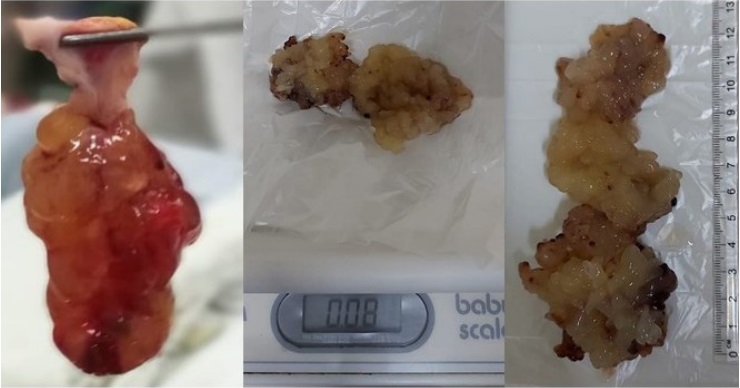 La imagen muestra la pieza quirúrgica, el tamaño y peso del mixoma, que posee una longitud de 13 centímetros y un peso de 0,08 gramos.