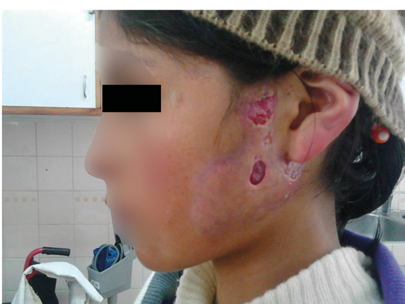 Fixed cutaneous sporotrichosis in the left pre auricular region.