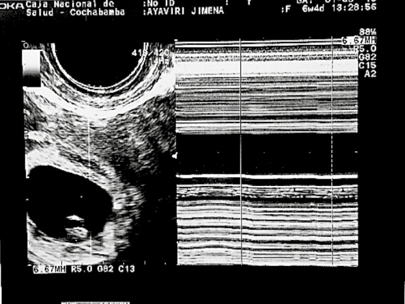 Transvaginal ultrasound orthotopic gestational sac with single live 7 mm LCC embryo with cardiac activity