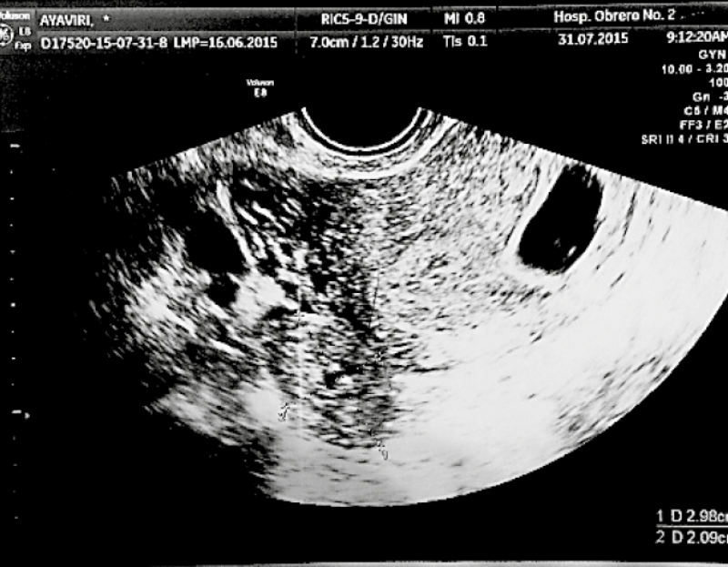 31 x 19 mm ovoid adnexal formation in right adnexa; heterotopic pregnancy: one 6.4 week viable intrauterine and one right tubal ectopic.