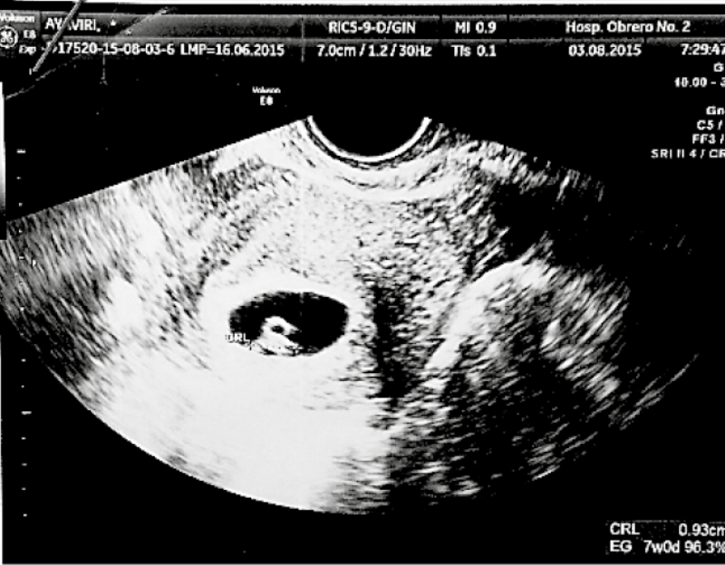 Transvaginal ultrasonography: single live embryo of 9.3 mm LCC, with cardiac activity