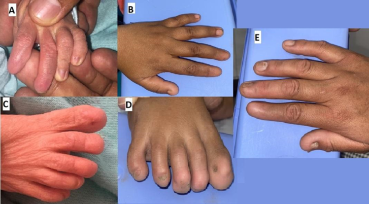 Anoniquia total del digito 2 hipoplasia ungueal digitos 1 y 3 y digitos 4 y 5 normales Recien Nacido panel A y C hermana Panel B y D Madre panel E