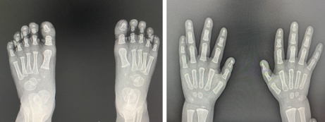 Radiografía de pies y manos falanges normales