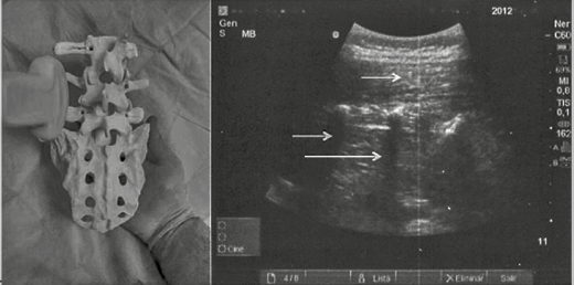 Abordaje longitudinal (sagital) paramedial. Identificación de apófisis transversas