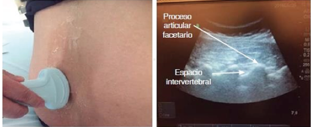 Abordaje longitudinal donde se observan los espacios intervertebrales y la imagen en dientes de serrucho o nudillos de puño de mano.