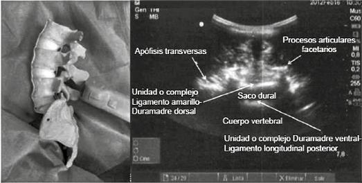 Representación del espacio intervertebral en un abordaje transversal con todos los elementos identificables. Corte que permite medir las distancias entre piel y ligamento amarillo, asi como la continuidad del mismo, imagen de ?murciélago volando?