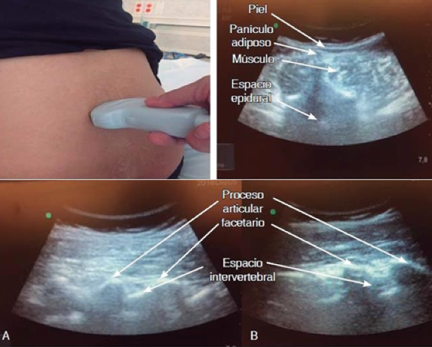 abordaje transversal en donde se observa la apófisis espinosa, láminas, masa muscular común, espacio epidural y canal medular. 7: Imagen a nivel L3-L4 en donde se muestran las diferencias anatómicas ultrasonografías entre dos voluntarios. 7.A Femenino de 1.56m e IMC 28 y 7.B masculino de 1.70m e IMC 27.