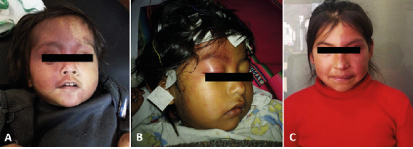 M&aacute;cula en vino de Oporto, con afectaci&oacute;n bilateral y afectaci&oacute;n extensa en hemicara derecha en territorio trigeminal (A). M&aacute;cula en vino de Oporto con afectaci&oacute;n del territorio de rama oft&aacute;lmica-trigeminal (B). M&aacute;cula en vino de Oporto en hemicara izquierda en territorio trigeminal, con signos leves de hipertrofia del labio superior en hemicara izquierda (C).