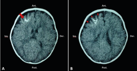 Corte axial de tomograf&iacute;a computarizada (TC) sin contraste en un paciente con s&iacute;ndrome de Sturge-Weber, donde se evidencia calcificaci&oacute;n frontal izquierda de par&eacute;nquima cerebral (flecha); estudio imagenol&oacute;gico corresponde al paciente de la
              figura 1-B (A). Se puede evidenciar una atrofia cortical frontal (flechas) (B).
            