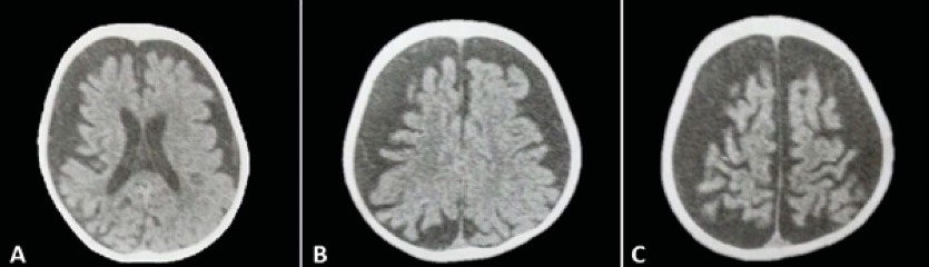 Tomograf&iacute;a computarizada (TC) sin contraste, correspondiente al paciente de la
              figura 1-A. Se evidencia corte axial que muestra atrofia cerebral difusa; coincidiendo con el retraso psicomotor que presenta este paciente con s&iacute;ndrome de Sturge-Weber.
            
