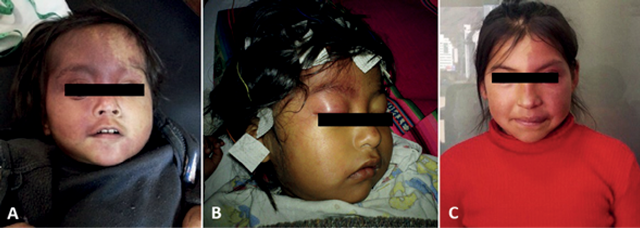 Port-wine stain with bilateral involvement and extensive involvement of the right hemiface in the trigeminal territory (A). Port-wine stain with involvement of the ophthalmic-trigeminal branch territory (B). Port-wine stain in left hemiface in trigeminal territory, with mild signs of hypertrophy of the upper lip in left hemiface (C)