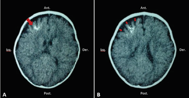 Axial computed tomography (CT) scan without contrast in a patient with Sturge-Weber syndrome, showing left frontal calcification of brain parenchyma (arrow); the imaging study corresponds to the patient in figure 1-B (A). Frontal cortical atrophy can be evidenced (arrows) (B).