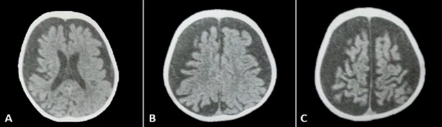 Computed tomography (CT) scan without contrast, corresponding to the patient in figure 1-A. Axial slice showing diffuse cerebral atrophy; coinciding with the psychomotor retardation presented by this patient with Sturge-Weber syndrome.