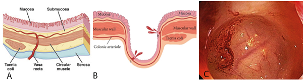 A) Representaci&oacute;n de la pared normal de colon. B) Pared de un diverticulo de colon con sangrado. C) Imagen endoscopica de un diverticulo con estigma de sangrado observando a nivel de fondo diverticular
