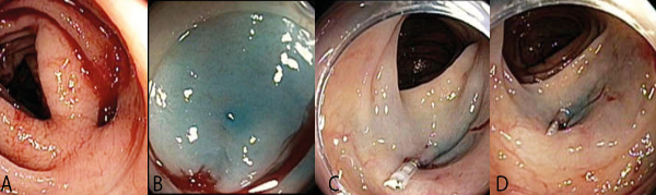 A) Diverticulo de colon con sangrado activo B) Marcacion con infiltraci&oacute;n submucosa de azul de metileno C) Ingreso con capuchon y aplicaci&oacute;n de endoclip D) Hemostasia posterior a terapia combinada adrenalina, clip, irrigaci&oacute;n con &aacute;cido tranex&aacute;mico