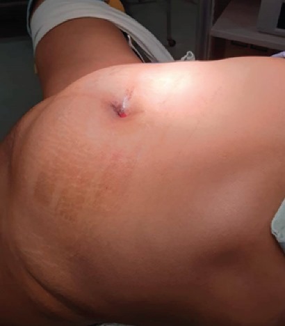 Posición de la paciente, en trendelemburg forzado a 45º, se colocarón 4 trocares, con la pierna en abducción.