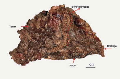 Pieza quirúrgica, tumor completo, con borde de vejiga libre e tumor.