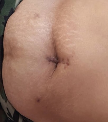 Heridas cicatrizadas en los controles, sin datos de recurrencia