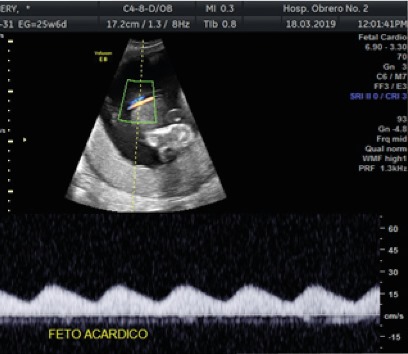 Demostraci&oacute;n por Doppler de flujo en la arteria umbilical &uacute;nica hacia el feto acardio.