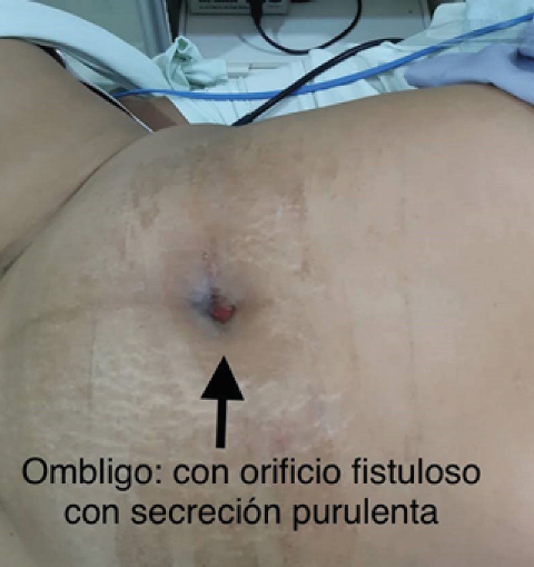 Fistula in the umbilicus, with outflow of purulent material from urachal tumor.