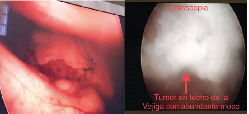 Control cystoscopy, showing evidence of bladder dome tumor, with abundant mucus and cellular detritus, involving a large part of the bladder roof.