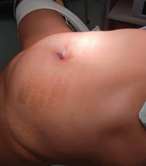 Patient position, in forced trendelemburg at 45&ordm;, 4 trocars were placed, with the leg in abduction.