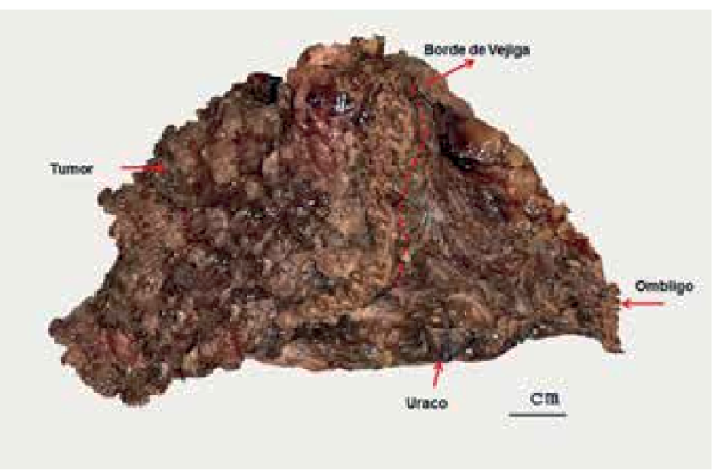 Surgical specimen, complete tumor, with free bladder border and tumor.
