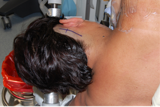 Paciente en posición tres cuartos prono con el tórax elevado: