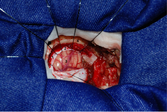 Microcraniectomía asterional derecha.