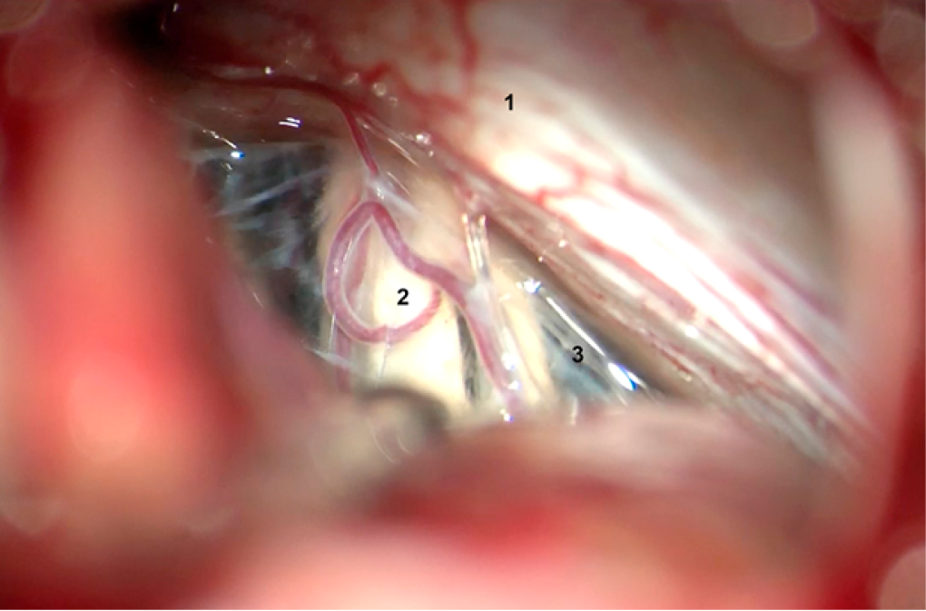 Vista quirúrgica del ángulo pontocerebeloso bajo visión microscópica