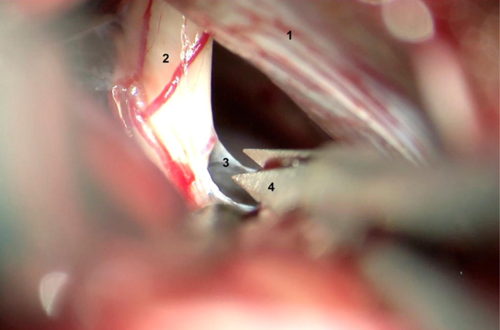 Disección cortante con microtijera.