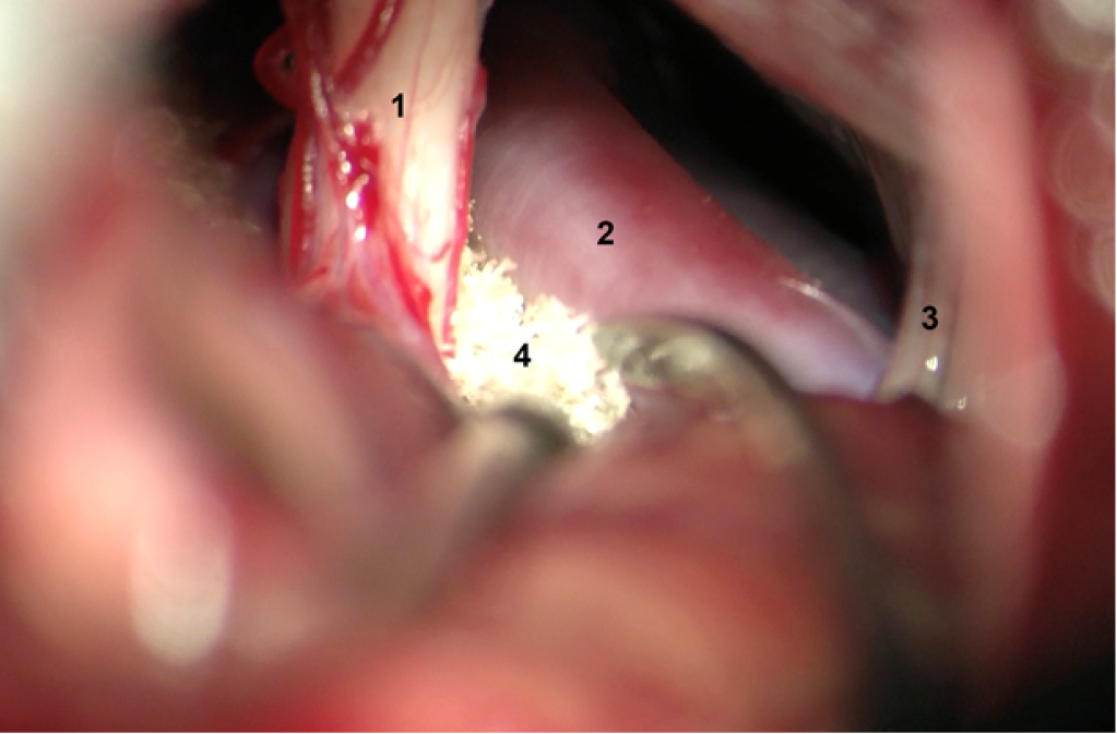 Descompresión microvascular, el nervio facial aislado de la arteria mediante teflón.