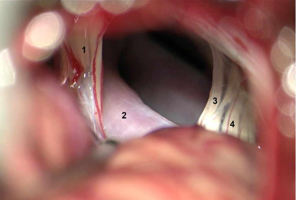 ompresión del nervio facial por la arteria basilar dolocoectasica.