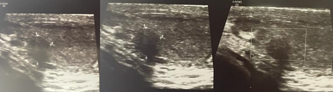 Ecograf&iacute;a testicular Lesi&oacute;n heterog&eacute;nea de 2 cm de di&aacute;metro m&aacute;ximo dependiente de polo inferior de test&iacute;culo izquierdo