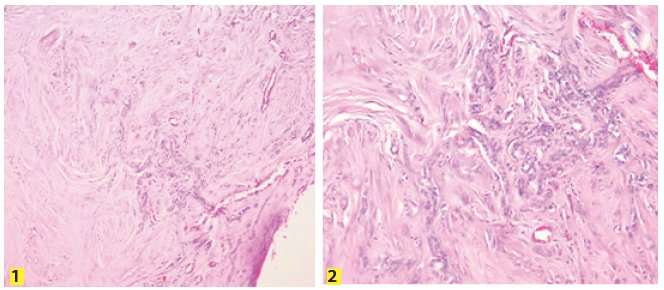Microfotograf&iacute;as con aumento 10x, en la que se observa una neoplasia circunscrtita, limitada al par&eacute;nquima testicular, con extensas &aacute;reas de esclerosis.