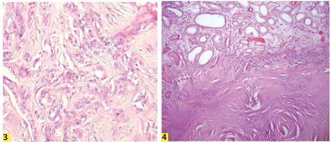 Microfotograf&iacute;as con aumento 40x, en las que se evidencia que el escaso componente celular est&aacute; compuesto por estructuras tubulares y cordones de c&eacute;lulas cuboidales con escasa atipia, citoplasma moderado p&aacute;lido