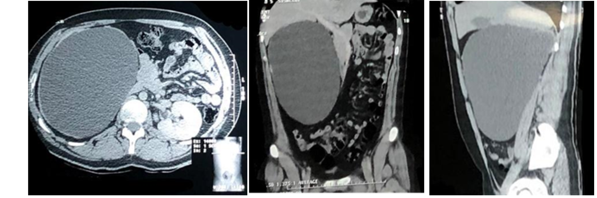 La tomograf&iacute;a computarizada de abdomen mostr&oacute; hidronefrosis gigante derecha 26x17x15 cm en vista axial (A) coronal (B) y sagital (C).