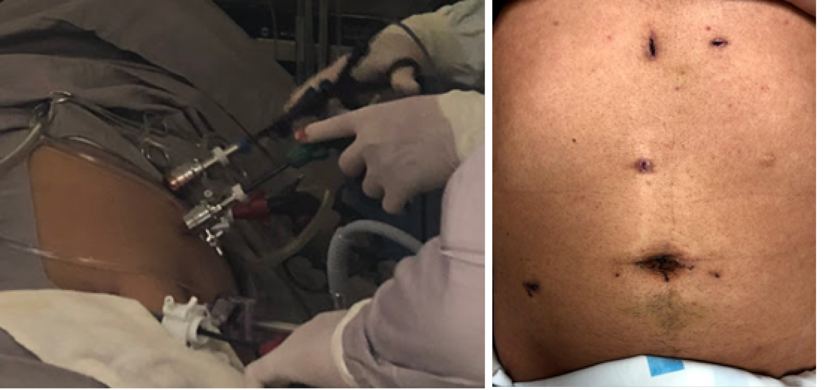 Cirug&iacute;a v&iacute;a laparosc&oacute;pica, utilizando un abordaje transperitoneal Se utiliz&oacute;: un puerto de 10 mm subxifoideo, 1 puerto de 12 mm umbilical, cuatro puertos de 5 mm:(dos en linea media, uno pararectal derecho, uno subcostal izquierdo.