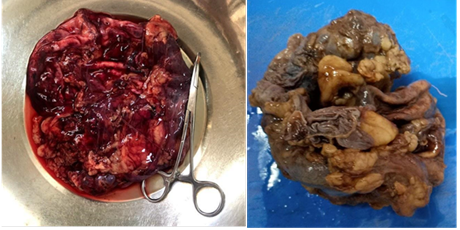 Ri&ntilde;&oacute;n derecho, colapsado, con p&eacute;rdida de la anatom&iacute;a, compatible con hidronefrosis con tejido adiposo perirrenal