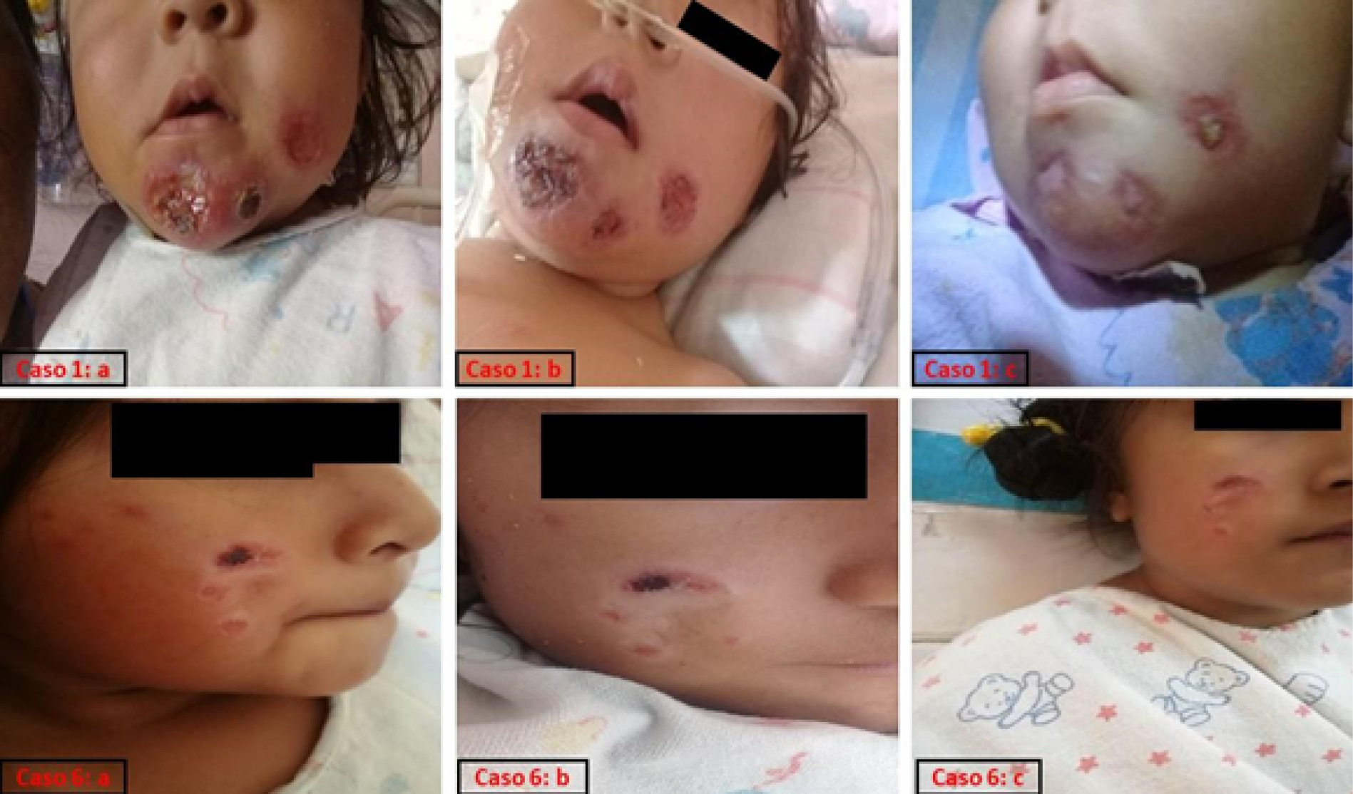 Evolución de las úlceras cutáneas por leismania de los pacientes pediátricos 1 y 6 durante el tratamiento con Anfotericina B liposomal.