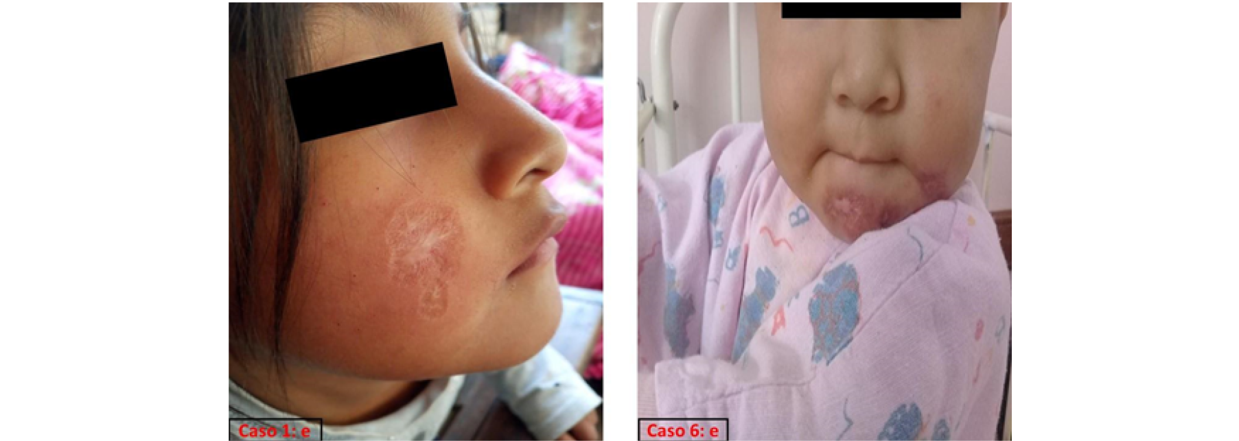 Cicatriz de las úlceras cutáneas por leismania de los pacientes pediátricos 1 y 6 a los tres meses post tratamiento con anfotericina B liposomal. e=tres meses post tratamiento.