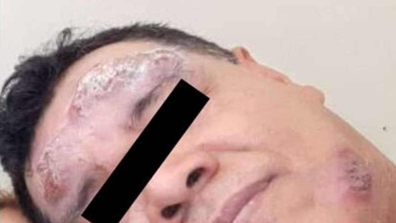 Paciente con lesiones múltiples de Leishmaniasis en proceso de epitelización a la finalización (28 días) del tratamiento combinado de tres drogas antileishmania.