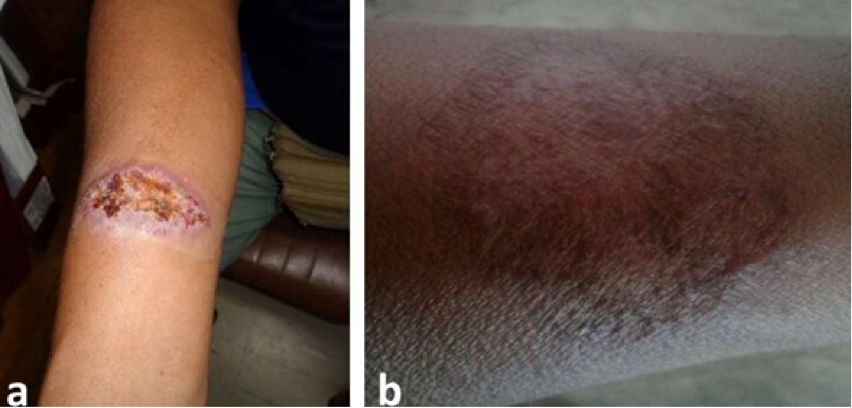 Lesión en antebrazo derecho antes y después del tratamiento combinado con Pentamidina, Miltefosina y Paromomicina. a= Antes del tratamiento combinado; b=Lesión cicatrizada completamente al primer mes pos tratamiento combinado.